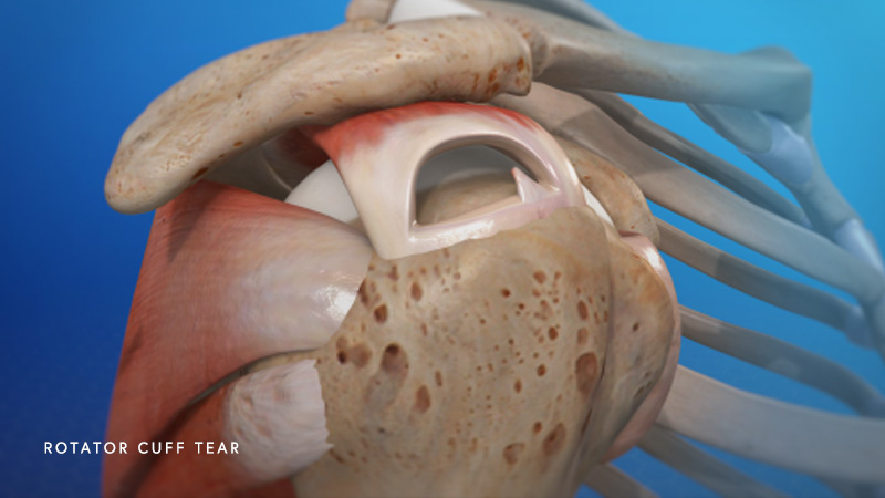 Rotator Cuff Tear - Center for Orthopedic Specialists